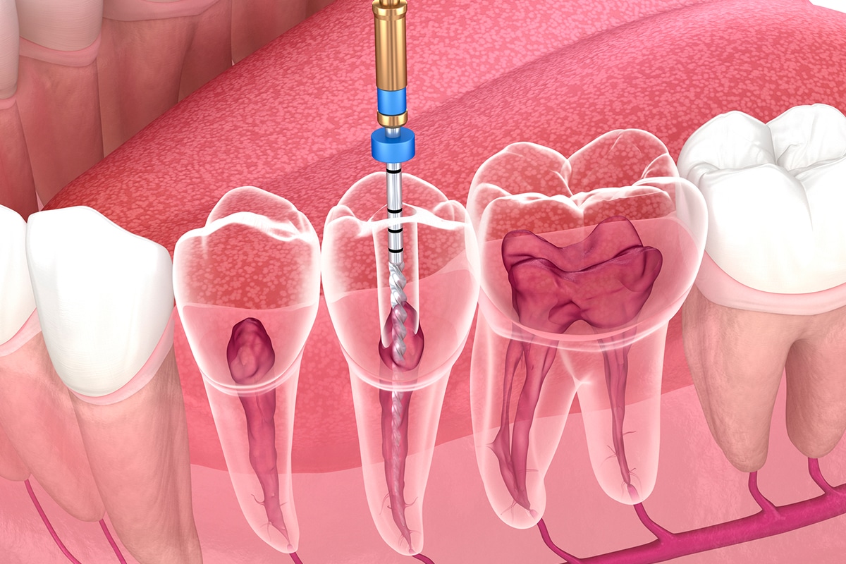 Endodontics